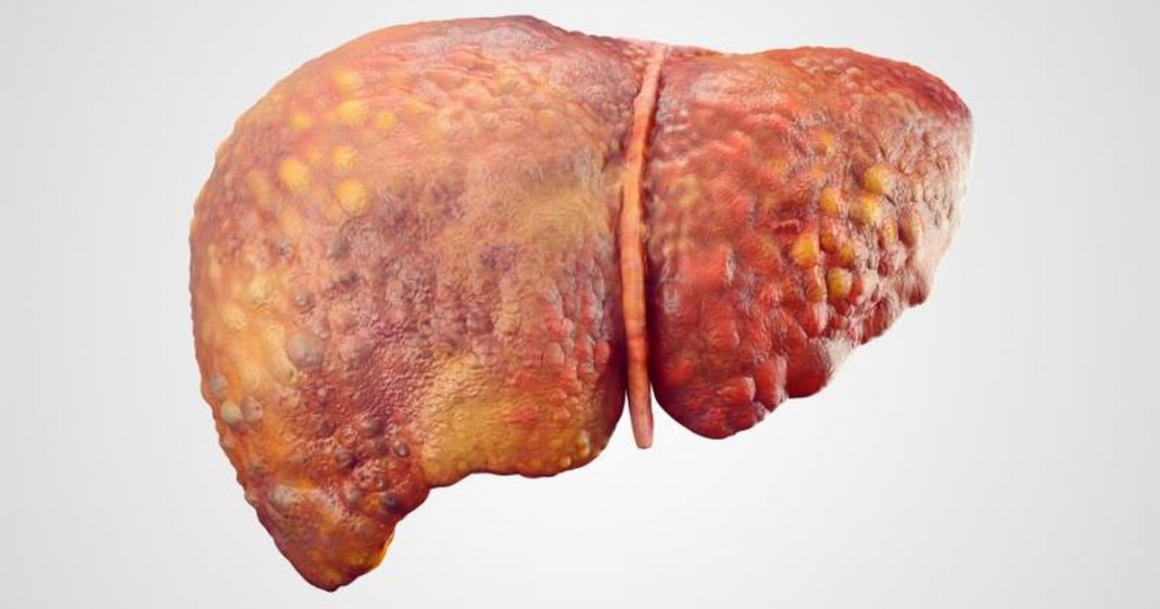 fatty-liver-disorder-contributes-to-cardiovascular-disease-and-vice